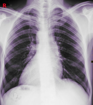 Dextrocardia Chest X-ray
