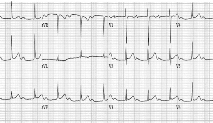 Figure.1. A 12-lead ECG shows constant, prolong PR interval (>200 milliseconds) with 1:1 association of P and QRS, consistent with first degree atrioventricular block.