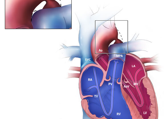 Coarctation of the Aorta