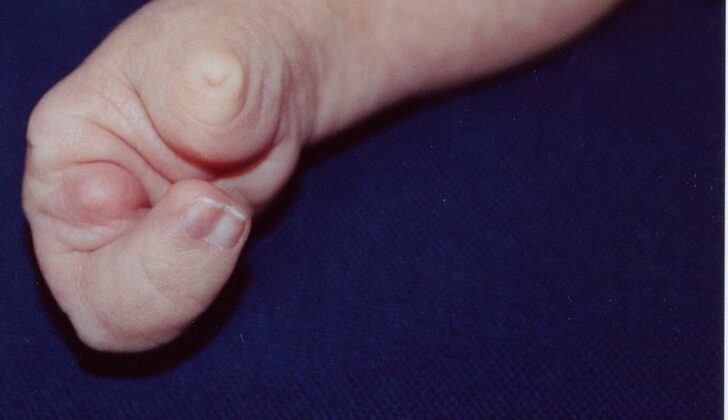 Ectrodactyly on a young child.