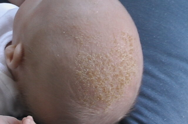 cradle cap