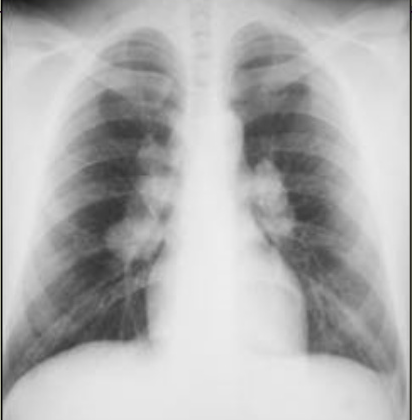 Bilateral Hilar Adenopathy
