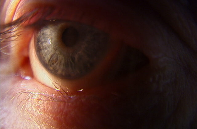 Trichiasis at a site of prior trauma to the lower eyelid