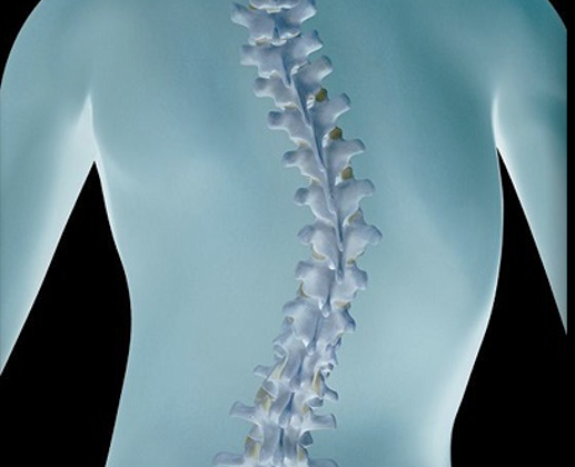 scoliosis of the spine
