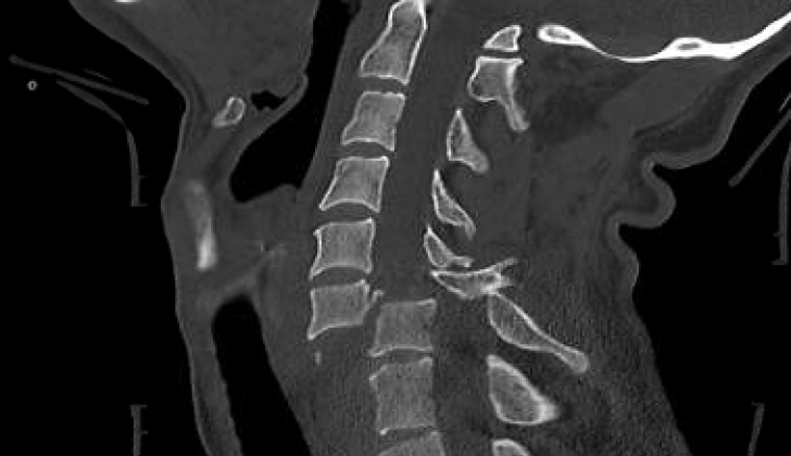 Bilateral Facet Fracture Dislocation of the Cervical Spine