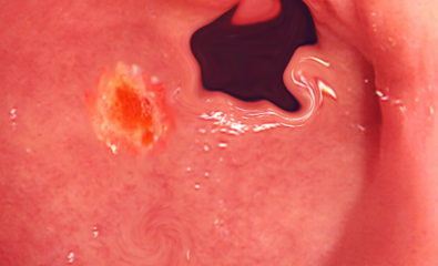 Duodenal ulcer