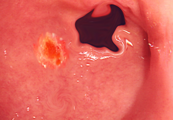 Duodenal ulcer