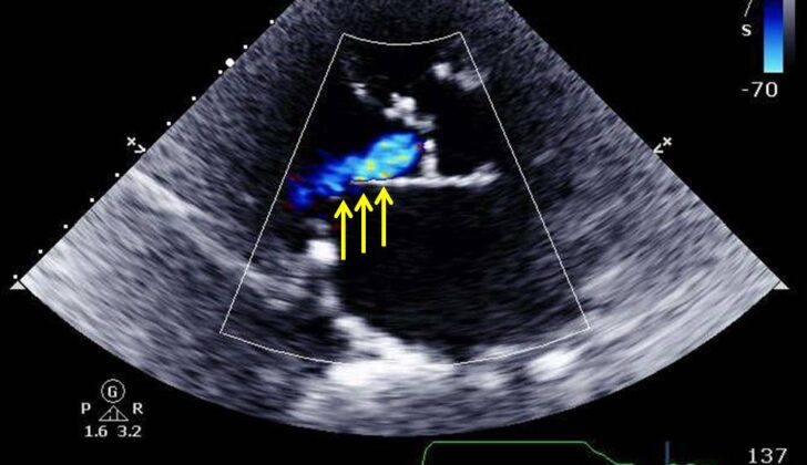 Parasternal long axis echocardiographic view of aortic insufficiency (yellow arrows) striking the anterior mitral leaflet in an 85 year old woman with concomitant aortic stenosis presenting with shortness of breath.