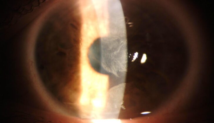 Figure 1. Slit lamp image of Advancing Wavelike Epitheliopathy