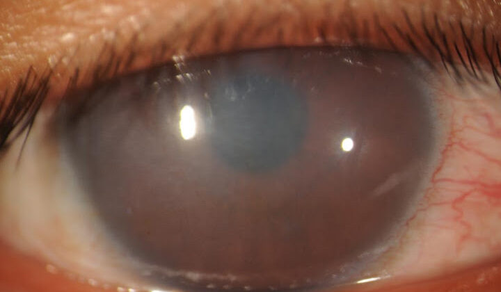 Congenital Hereditary Endothelial Dystrophy