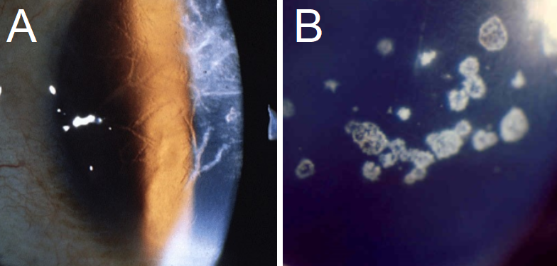 A: Typical branching opacities found in Lattice Corneal Dystrophy. B: A clear
presentation of Granular Corneal Dystrophy, with crumb-like opacities separated
by clear corneal surface space.