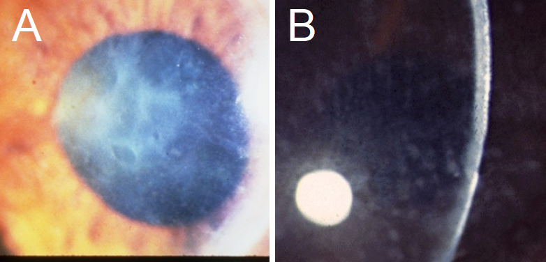 A: Reis-Bucklers Corneal Dystrophy presents with erosions and biomicroscopic
findings similar to EBMCD, with geographic, map-like erosions on the corneal
surface. Note the background corneal haze, which is often not seen in EBMCD. B:
Macular Corneal Dystrophy presents with a diffuse ground glass-like opacity, as
seen in this cornea from the side.