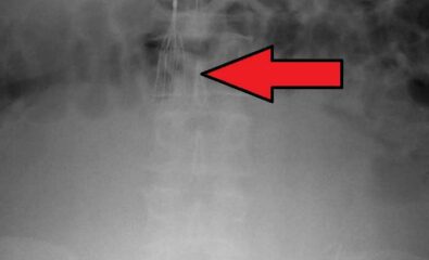 Inferior vena cava (IVC) filter as seen on plain X ray of the abdomen