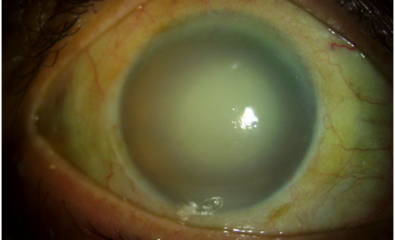 After treatment with topical and systemic steoids and antiglaucoma medications, corneal edema decreased and a mature cataract was seen which was the reason for the lens induced inflammation.