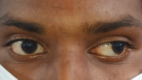 Digital image of the patient depicting an exotropia of approximately 40 degrees while the patient is fixing with his right eye