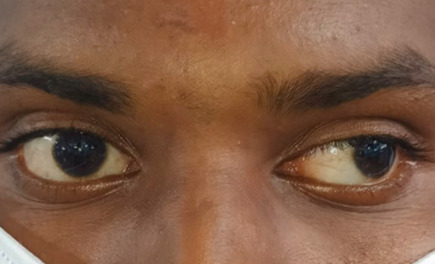 Digital image of the patient depicting an exotropia of approximately 40 degrees while the patient is fixing with his right eye