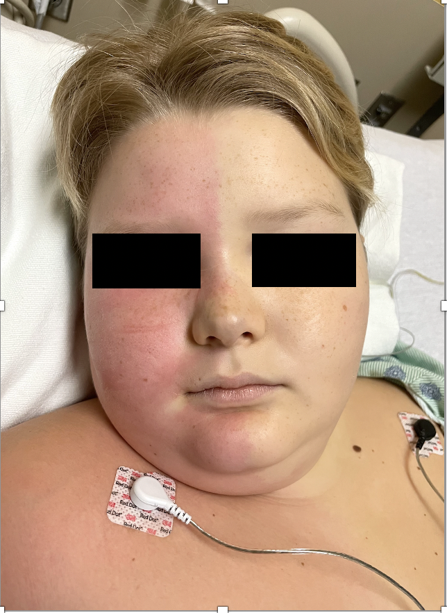 Figure 1: Harlequin syndrome; Unilateral facial flushing sharply demarcated in
the midline from the contralateral pallor