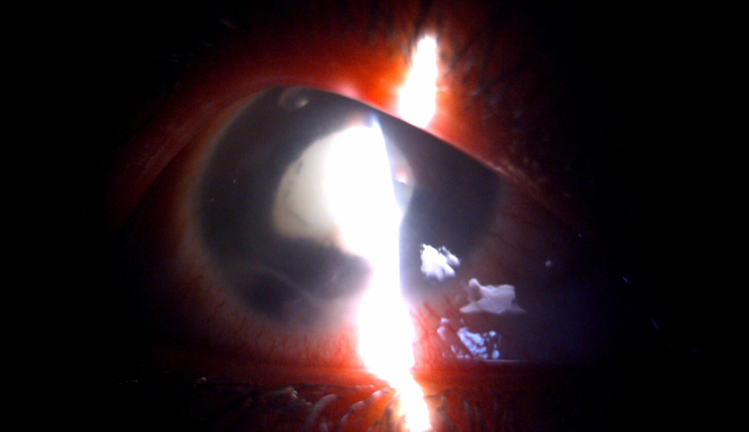 Lens Abscess - MD Searchlight