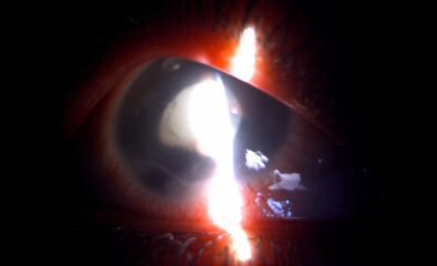 Digital slit lamp image of the patient depicting corneal tear with heteregenous lenticular opacity suggestive of lens abscess