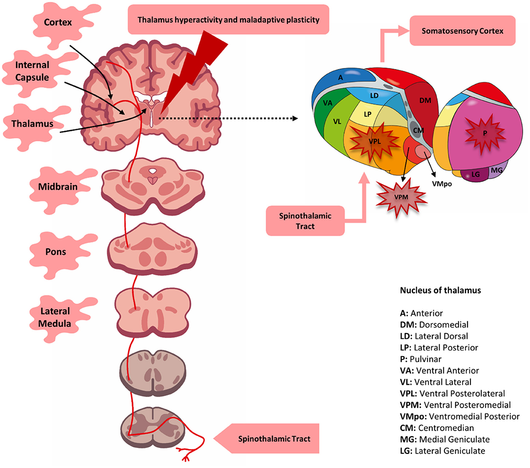 Central Post-Stroke Pain Syndrome (Stroke Pain) - MD Searchlight