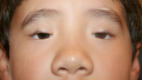 Male child with blepharophimosis syndrome. Demonstrating the classic findings of blepharophimosis, ptosis, and epicanthus inverus in each eye, and telecanthus.