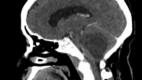 Computed tomography With Contrast. Sagittal view of a hemangioblastoma on computed tomography.
