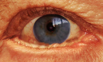 entropion of the eye