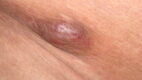 Angiolymphoid Hyperplasia With Eosinophilia. Angiolymphoid hyperplasia with eosinophilia, also known as epithelioid hemangioma, is an uncommon, benign vasoproliferative disorder.