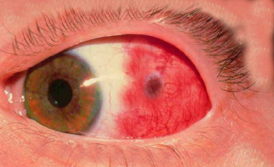 episcleritis of the eye
