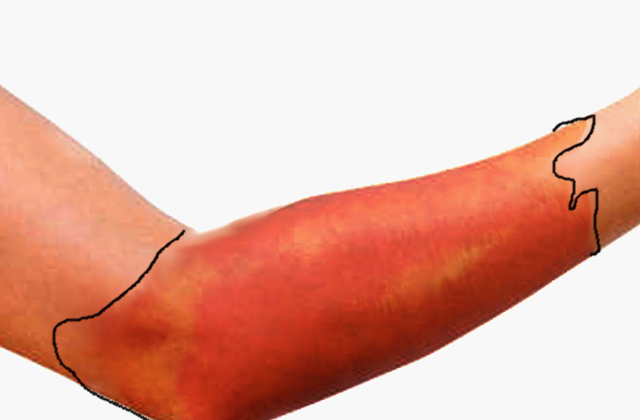Erysipelas