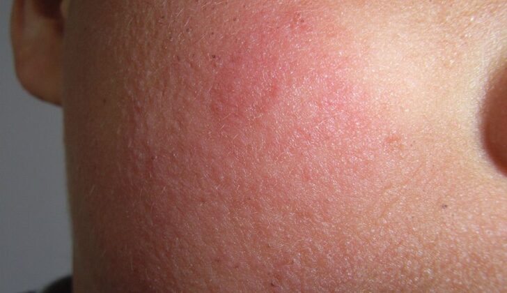 Fifth Disease, Face rash