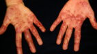 Erythema Multiforme