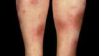 Erythema Nodosum