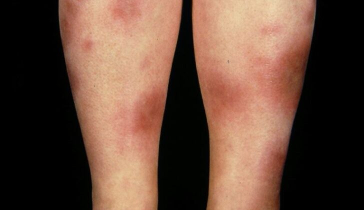 Erythema Nodosum