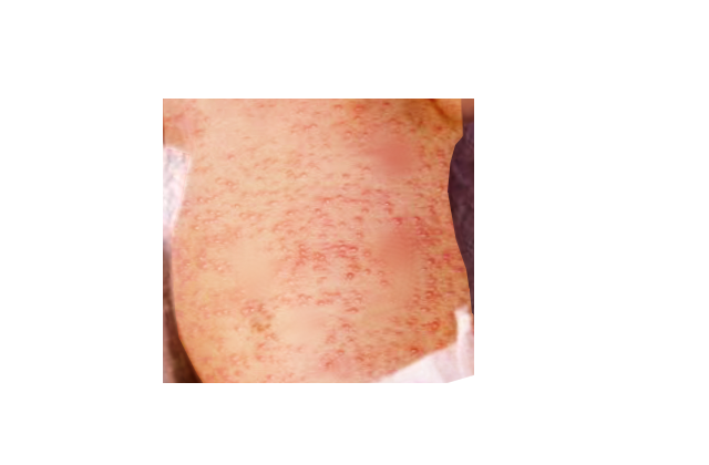 Erythema toxicum
