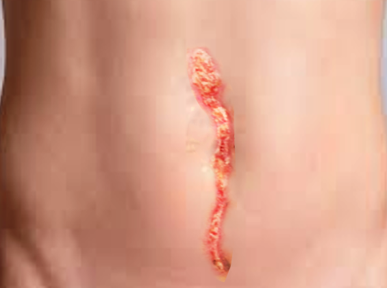 Wound dehiscence