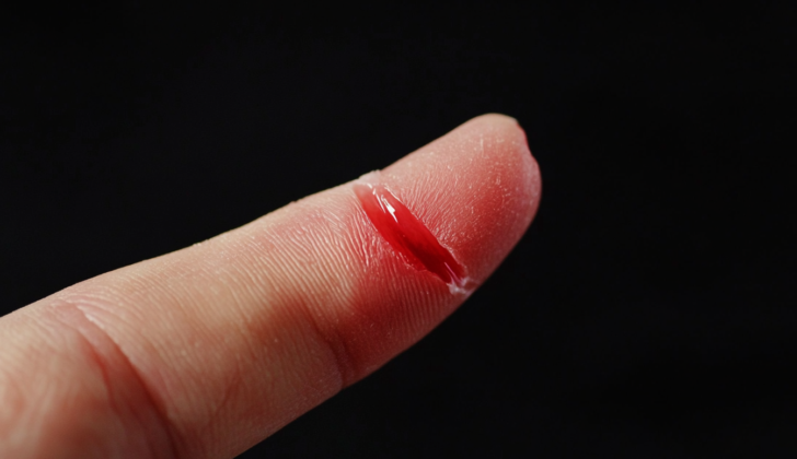 Fingertip Injury