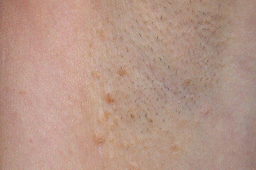 Fox-Fordyce Disease