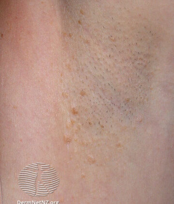 Fox-Fordyce Disease