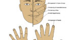 Acromegaly, Gigantism. Illustrated image of physical attributes of acromegaly of the face and hands. 