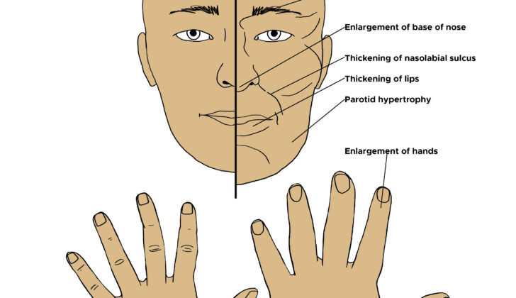 Acromegaly, Gigantism. Illustrated image of physical attributes of acromegaly of the face and hands. 