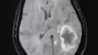 Peripheral Ring Enhancement Pattern of Glioblastoma Multiforme in Contrast MRI Brain