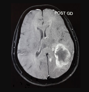 Peripheral Ring Enhancement Pattern of Glioblastoma Multiforme in Contrast MRI Brain