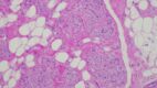 Granular Cell Tumor