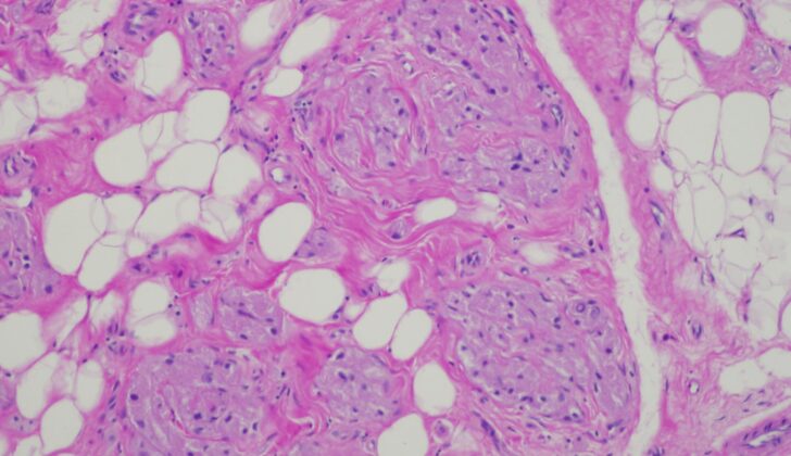 Granular Cell Tumor