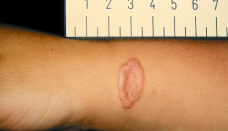 Granuloma Annulare