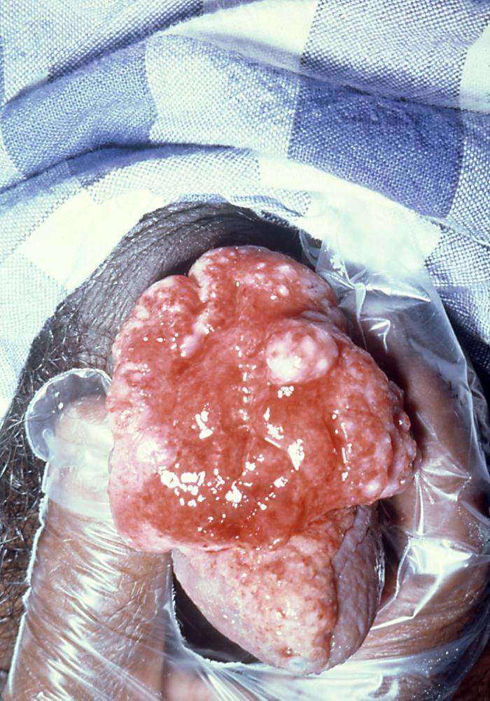 Granuloma Inguinale. The image depicts a male patient’s glans penis that
exhibited an ulcerative lesion, diagnosed as granuloma inguinale. However, due
to its appearance, it initially appeared to be carcinoma. Granuloma inguinale,
also known as donovanosis, is a sexually transmitted disease caused by the
bacterium Klebsiella granulomatis, formerly Calymmatobacterium granulomatis.