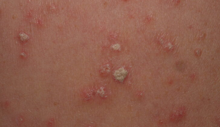 Guttate Psoriasis
