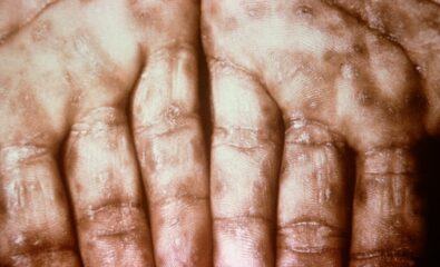 Keratotic Lesions on the Palms. This photograph shows a close-up view of keratotic lesions on the palms of a patient’s hands due to a secondary syphilitic infection. Syphilis is a complex sexually transmitted disease (STD) caused by the bacterium Treponema pallidum. It has often been called “the great imitator” because many signs and symptoms are indistinguishable from those of other diseases.