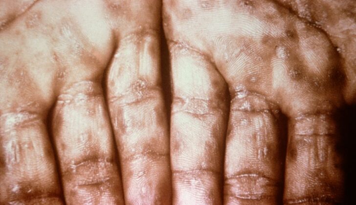 Keratotic Lesions on the Palms. This photograph shows a close-up view of keratotic lesions on the palms of a patient’s hands due to a secondary syphilitic infection. Syphilis is a complex sexually transmitted disease (STD) caused by the bacterium Treponema pallidum. It has often been called “the great imitator” because many signs and symptoms are indistinguishable from those of other diseases.